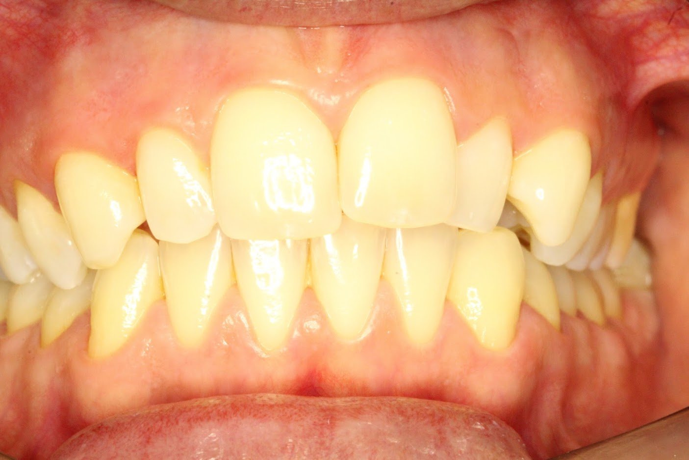 Before treatment: Clear aligners