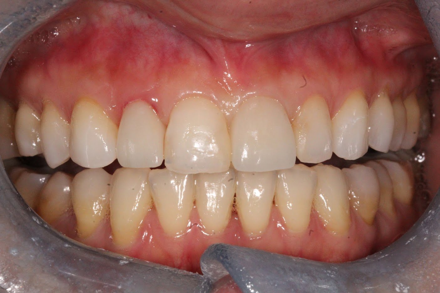 After treatment: Crowns