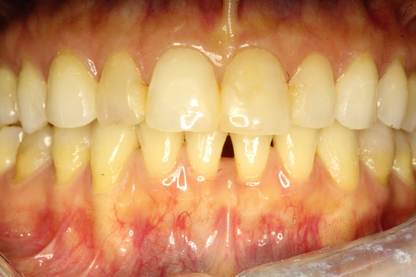 Before treatment: Crowns
