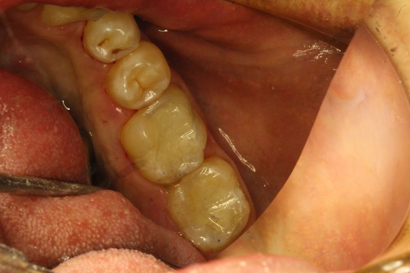 After treatment: White fillings